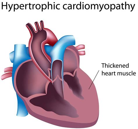 Hypertrophic cardiomyopathy .